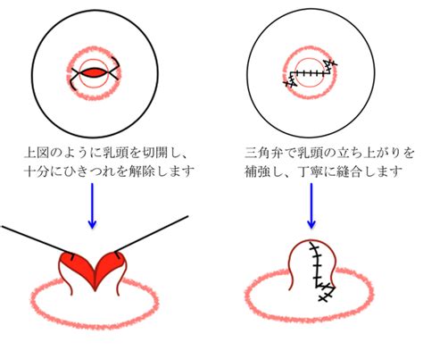 仮性陥没乳首|陥没乳頭（陥没乳首）とは 